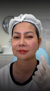 Với mong muốn tìm kiếm một giải pháp trẻ hóa lâu dài nhưng không làm mất đi  những nét đặc trưng vốn có trên gương mặt, chị khách đã lựa chọn Radiesse  dưới sự tư vấn của bác sĩ Thúy. Là một chất tăng ...