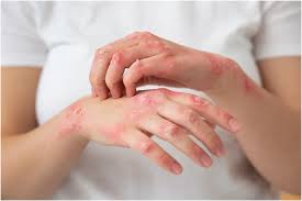 Image result for scabies on humans