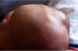 Image result for Vacuum Caput