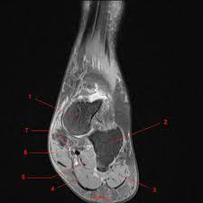 It arises from the base of the fifth metatarsal bone, and from the sheath of the fibularis longus. Mri Of The Ankle Detailed Anatomy W Radiology
