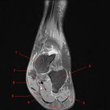 12 photos of the foot muscle anatomy mri.magnetic resonance imaging (mri) is the modality of choice in diagnosing accessory muscles, delineating their relationship to adjacent structures, and differentiating them from soft tissue tumors. Mri Of The Ankle Detailed Anatomy W Radiology