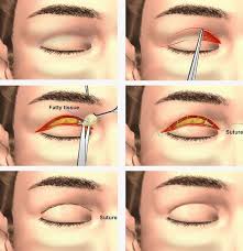 Cosmeticsurgerymexico Blepharoplasty Procedure Eyelids Upper Lower For Theupper Blepharoplasty Procedure Cosmetic Surgery Plastic Surgery Rhinoplasty