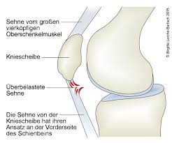 Sinding Larsen Krankheit Patellaspitzensyndrom Deximed