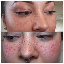 Microblading Freckles Before And After Sok Pa Google Permanent Makeup Tattooed Freckles Freckles