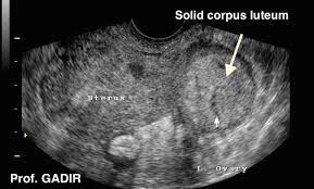 Image result for corpus luteum sonography)