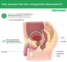 Anejakulation Definition Einer Ausbleibenden Ejakulation