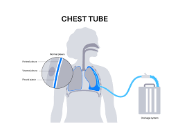Image result for Chest Tube