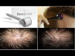 Clinically proven to nourish thinning hair and promotes existing hair growth. How To Use The Dermaroller To Regrow Hair Stop Hair Loss And Grow Hair On Receding Hairline Youtube Regrow Hair Stop Hair Loss Grow Hair