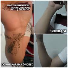 Gecici Makyaj Kamuflaj Sistemi Dovme Vitiligo Dogum Lekesi Ve Buna Benzer Cilt Kusurlarini Kapatmak Icin Whatsapp Bilgi Hattimizda Makyaj Uzmani Makyaj Dovme