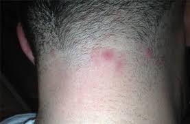 An ingrown hair happens when the sharp tip of the hair curls back or grows sideways into the skin of the hair follicle.it is a benign condition, which usually appears as a small tan or sometimes pink bump under the skin. Are These Ingrowns Folliculitis Pseudo Folliculitis Pimples Help Theshaveden