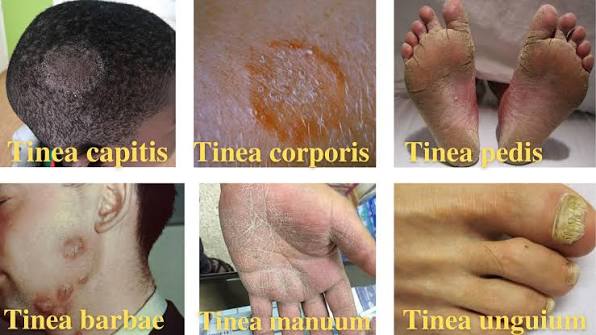 Types of Tinea (Ringworm): Sites, Causes, and Clinical Features &mdash; Microbe  Online