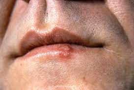 Ulceras Llagas En Los Labios Inflamacion De Los Labios Y Otros Cambios Trastornos Bucales Y Dentales Manual Msd Version Para Publico General