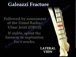 Image result for Galeazzi Sign