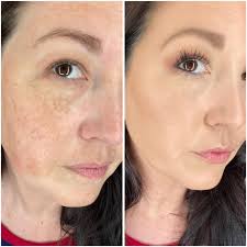 What is best for brown skin spots and brown moles?