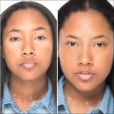 Vitiligo Concealer Starter Kit