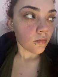 I've had 8 days of posterior epistaxis (nose bleed). Blood is super warm  and Steady stream. Comes with no warnings, harder to stop than anterior  epistaxis. Probably not PGC related just another