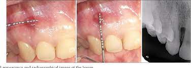 Treatment Of Lateral Periodontal Cyst With Guided Tissue Regeneration Semantic Scholar