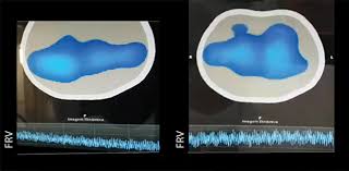 922185565 diagnostico clinico de muerte encefalica (real decreto 1723/2012 de 28 de. Use Of Cpap As An Alternative To The Apnea Test During The Determination Of Brain Death In Hypoxemic Patients Report Of Two Cases