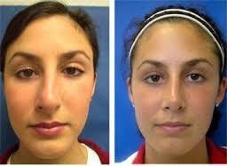 If You Have Been Looking Some Expert Opinion On Rhinoplasty And Nose Surgery Then You Should Definitely Visit Rhinoplasty Crooked Nose Rhinoplasty Nose Surgery