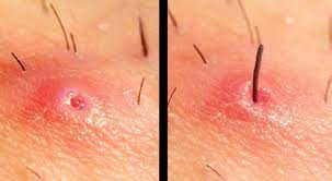 Ingrown hairs can wreak havoc on the area around it by creating painful inflammation which can be filled with fluid. What To Do When You Have Ingrown Hair Quickrecipes