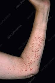 There are different types of purpura, and they can be signified by slight differences in color, location, and longevity. Medicine Diseases Ailments Skin Hair Nails Purpura Petechiae Stock Photos And Pictures Science Photo Library