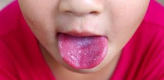 Maybe you would like to learn more about one of these? Warna Lidah Terang Berbiji Macam Strawberi Petanda Masalah Kesihatan Serius Sinar Plus