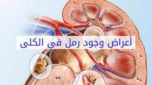 اعراض الكلى لها الكثير من الأعراض احساس ناعم