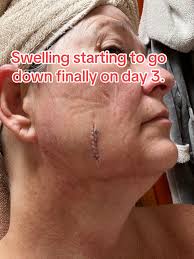 Mole Removal Recovery Time