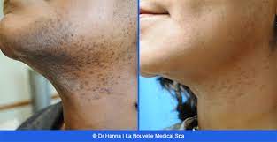 Eliminate unwanted body hair with laser hair removal at our camarillo medical spa. Laser Hair Removal Before And After Photos Oxnard Ventura
