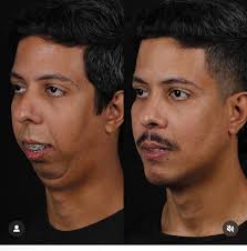 What did Kody do to his face?