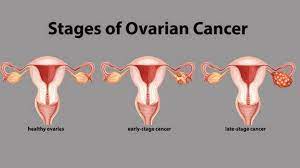 Ovarian cancer begins in the ovaries. Ovarian Cancer The Silent Killer Lifestyle General Kerala Kaumudi Online