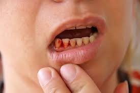 Image result for Post-Tooth Extraction Bleeding