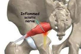 8 Cara Unik Mengatasi Piriformis Syndrom Di Bokong Mudah Rasa Sakit Kesehatan Gigi Kesehatan