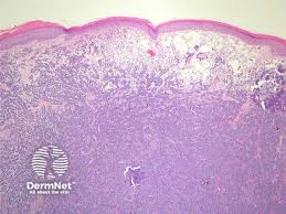 Image result for Merkel Cell Carcinoma