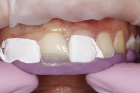 Dental Composite Comparison Venus Diamond Vs Estelite Omega Dental Composite Dental Dentistry