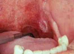 I am a 19 year old male. Oral Cancer Images The Oral Cancer Foundation