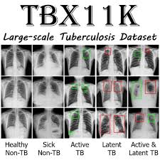 Visit cdc's latent tb infection online hub. Rethinking Computer Aided Tuberculosis Diagnosis ç¨‹æ˜Žæ˜Žä¸ªäººä¸»é¡µ