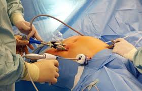 How long do these changes take? Cholecystectomy Gallbladder Surgery Symptoms Gallstones Laparoscopy