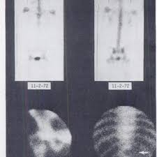Spine), west frisian rêchbonke (backbone). Pdf Cold Bone Lesions A Newly Recognized Phenomenon Of Bone Imaging