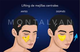 Pero los que muchos ignoran que una de las celebridades con más cirugías estéticas, en especial en su rostro. Bichectomia 3d Maternity Enflaquecer Solfa Syllable Superficie Reduccion De Cachetes Cirugia Plastica Reduccion De Cachetes
