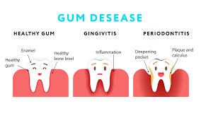 How To Eliminate Plaque & Stop Gum Disease | Dr. Dental