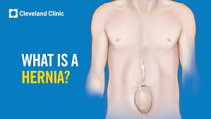 Image result for Inguinal hernia man