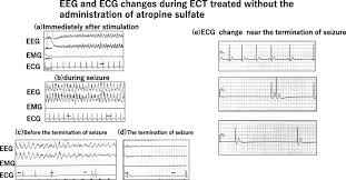 By hyperpolarizing the cells, vagal activation increases the cell's threshold for firin. Severe Bradycardia At The Termination Of Seizure During Electroconvulsive Therapy Ja Clinical Reports Full Text