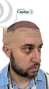 A 3 meses de su implante capilar, nuestro paciente nos cuenta su  experiencia!, No esperés más para recuperar tu cabello!, Recuperá tu imagen  y autoestima en @implantecapilar.bsas , Reservá tu cita ...