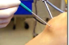 Exercises After Arthroscopic Knee Surgery Hurts So Badly But Time To Step It Up Arthroscopic Knee Surgery Knee Surgery Knee Surgery Recovery