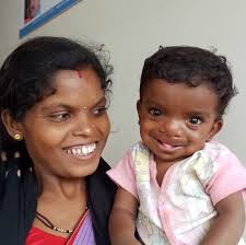 A before and after picture of Ayush Dhurwe highlights the transformative  impact of cleft surgery
