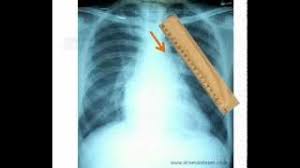 Straightening of the left heart border on a chest radiograph due to prominence of the left atrial appendage or the pulmonary outflow tract; Why Left Heart Border Become Straight In Mitral Stenosis Dr S Venkatesan Md