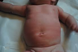 Newborn Eczema And Allergies Looking Back 4 Elle Steer Skin Allergies Milk Allergy Symptoms Baby Newborn Food