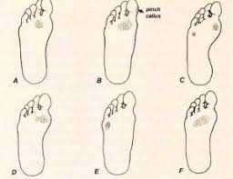 Foot Calluses Why Do You Get Them Neepawa Chiropractic And Massage Centre Foot Callus Told You So Foot Deformities