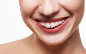 Have you ever wondered how long it takes to straighten your teeth with braces? How Long Will It Take To Straighten My Teeth Read More